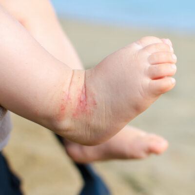 atopic dermatitis newborn feet eczema